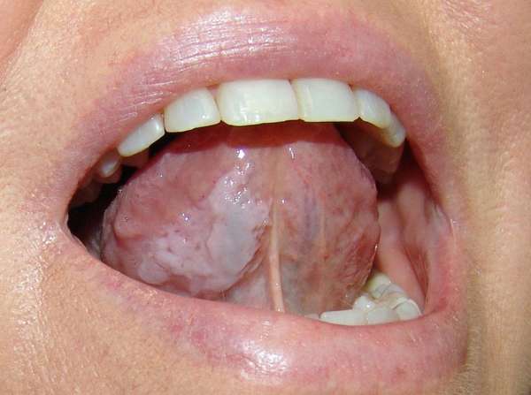 Сухость во рту может быть обусловлена различными заболеваниями