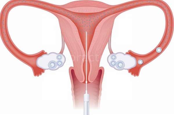 Перевязка труб делается для того, чтобы предотвратить беременность 
