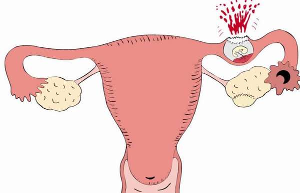 Чтобы вовремя обнаружить внематочную беременность, нужно регулярно посещать гинеколога 