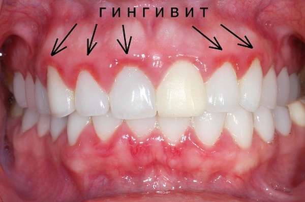 При воспалении десен следует немедленно обратиться к стоматологу за квалифицированной помощью