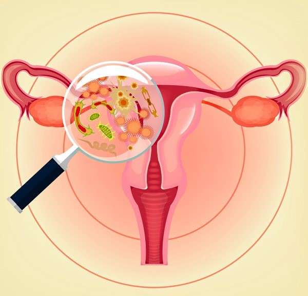 Бактериальный вагиноз развивается при снижении количества лактобацилл  