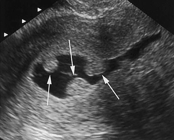 Можно ли беременеть с полипом в матке в конкретном случае, определяет врач после тщательного обследования 