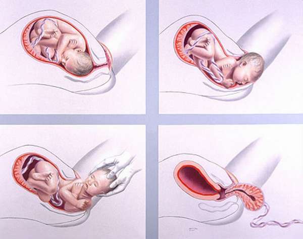 Если женщина рожает в первый раз, то у нее, как правило, наблюдаются затянувшиеся роды 