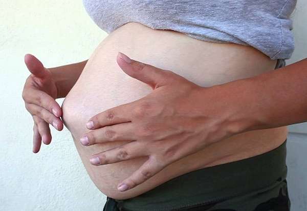 Пупочная грыжа при беременности может быть опасна при неправильном уходе за собой