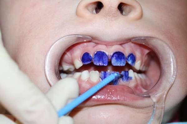 серебрение зубов