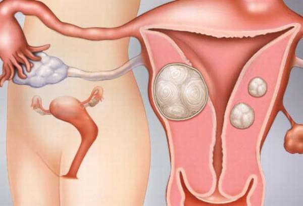 Достаточно часто после родов у женщины может появиться эндометрит 