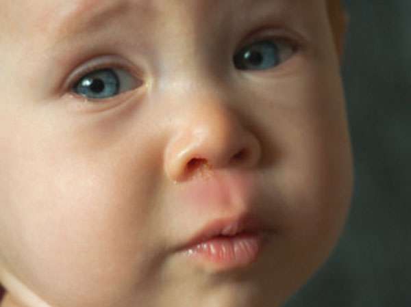 Раздражение под носом после насморка у ребенка