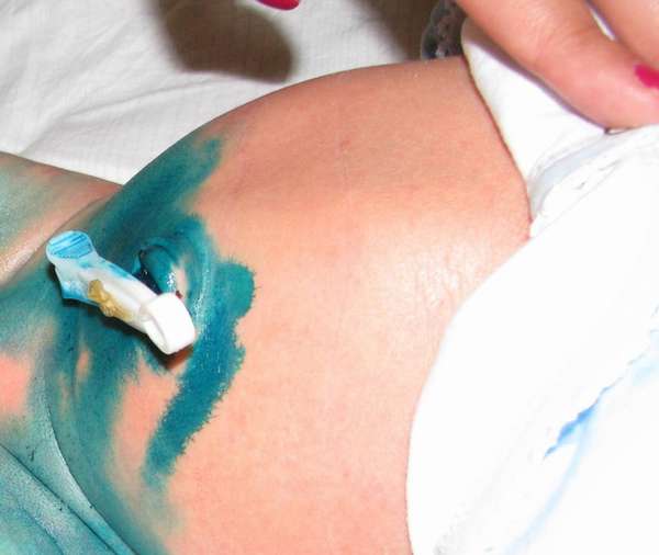 Обрабатывать пупок у новорожденного надо в стерильных условиях 